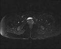 Bicornuate bicollis uterus (Radiopaedia 61626-69616 Axial PD fat sat 31).jpg