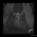 Bicornuate uterus- on MRI (Radiopaedia 49206-54297 Coronal STIR 18).jpg