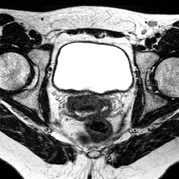 File:Bicornuate uterus (Radiopaedia 11104-11492 Axial T2 14).jpg