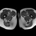 Bicornuate uterus (Radiopaedia 61974-70046 Axial T1 49).jpg