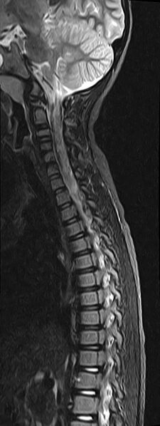 File:Bilateral Sprengel deformity with Klippel-Feil syndrome (Radiopaedia 66395-75650 Sagittal STIR 5).jpg