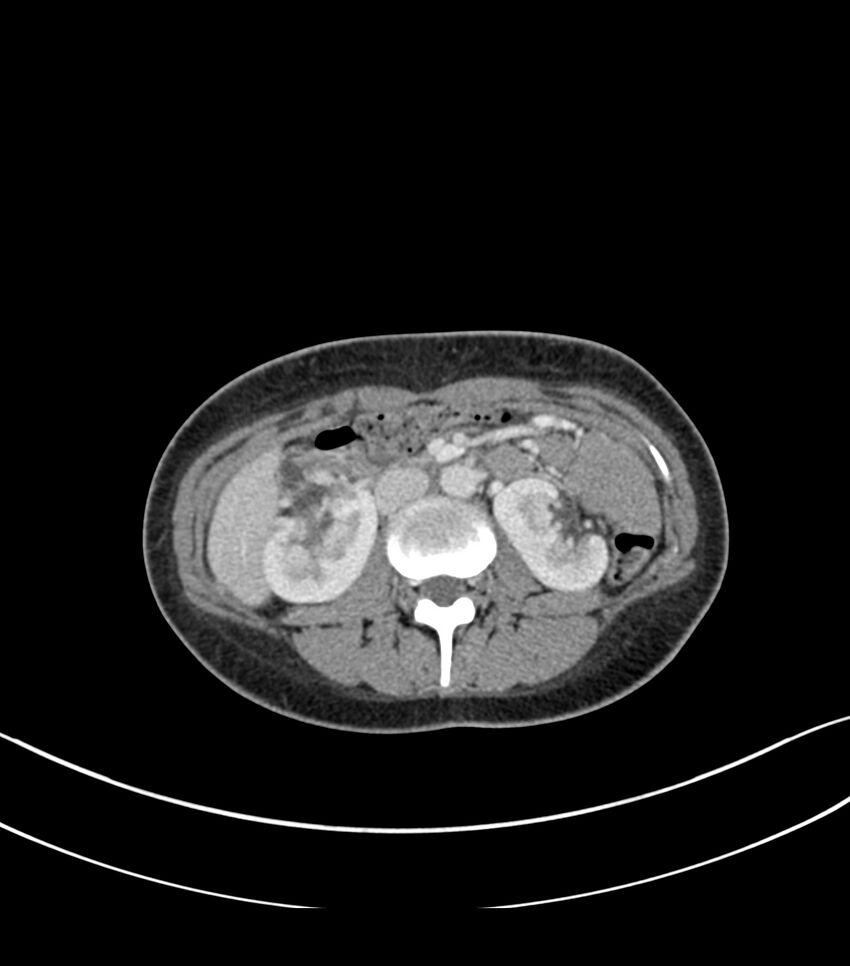 Bilateral kidney malrotation (Radiopaedia 72227-82749 A 23).jpg
