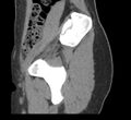 Bilateral mature cystic ovarian teratoma (Radiopaedia 88821-105592 D 3).jpg