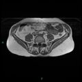 Bilateral ovarian fibroma (Radiopaedia 44568-48293 Axial T1 1).jpg