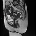 Bilateral ovarian fibroma (Radiopaedia 44568-48293 Sagittal T2 15).jpg
