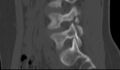 Bilateral pars defect (Radiopaedia 26691-26846 Sagittal bone window 22).jpg