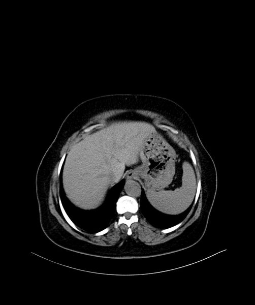 File:Bilateral sporadic synchronous clear cell renal cell carcinoma (Radiopaedia 85035-100572 Axial non-contrast 8).jpg