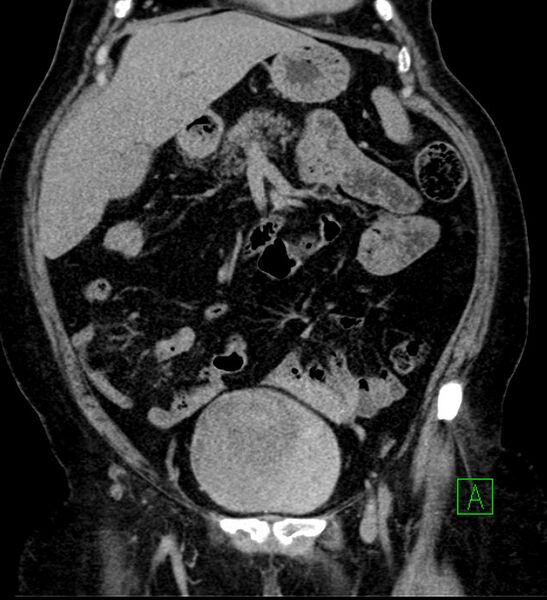 File:Bilateral sporadic synchronous clear cell renal cell carcinoma (Radiopaedia 85035-100575 I 13).jpg
