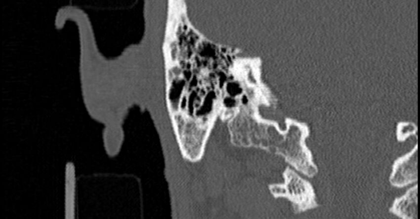 Bilateral temporal bone fractures (Radiopaedia 29482-29970 Coronal non-contrast 148).jpg