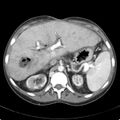 Biliary necrosis - liver transplant (Radiopaedia 21876-21846 B 22).jpg