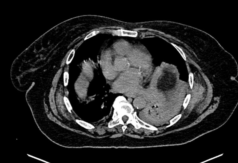File:Biliary pancreatitis (Radiopaedia 72289-82823 Axial non-contrast 11).jpg