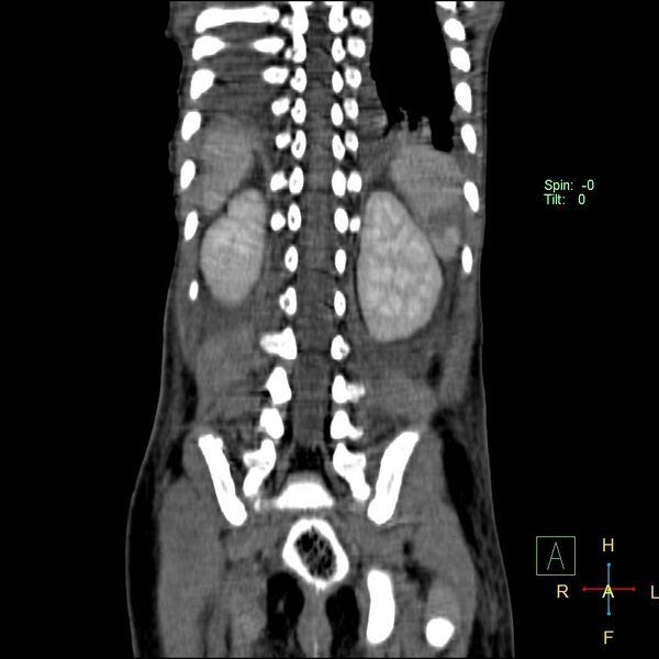 File:Blunt abdominal trauma (Radiopaedia 24780-25044 C 18).jpg