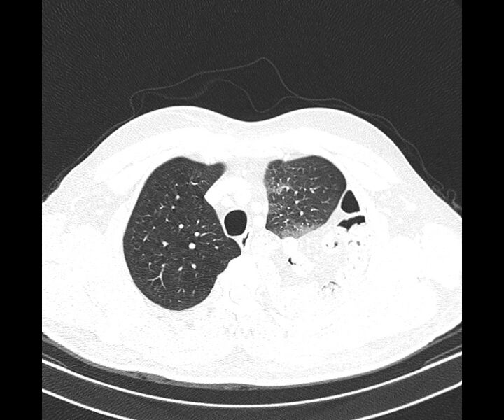 File:Bochdalek hernia - adult presentation (Radiopaedia 74897-85925 Axial lung window 9).jpg