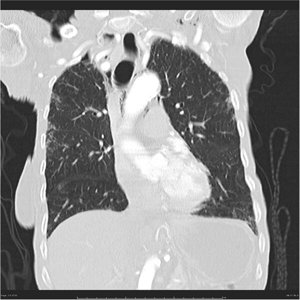 File:Boerhaave syndrome (Radiopaedia 26240-26362 Coronal lung window 13).jpg