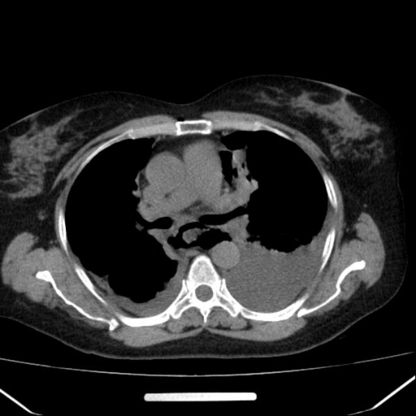 File:Boerhaave syndrome (Radiopaedia 45644-49799 Axial non-contrast 35).jpg