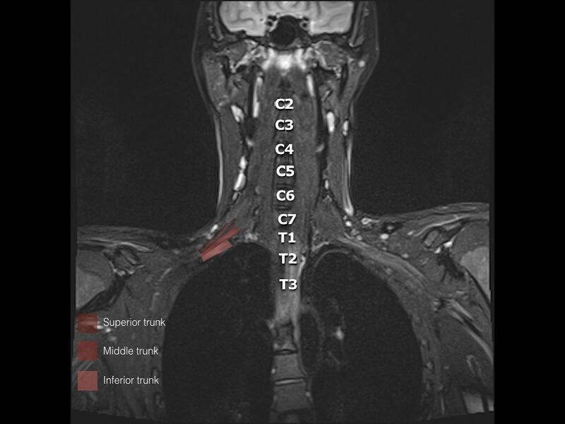 File:Brachial plexus anatomy (Radiopaedia 64414-73226 Coronal STIR 12).jpeg