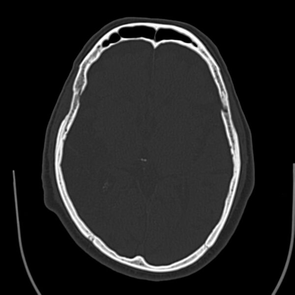 File:Brain Pantopaque remnants (Radiopaedia 78403-91048 Axial bone window 37).jpg
