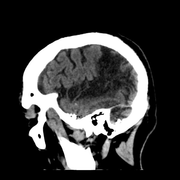 File:Brain Pantopaque remnants (Radiopaedia 78403-91048 C 12).jpg