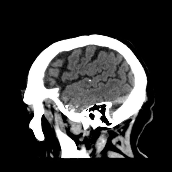 File:Brain Pantopaque remnants (Radiopaedia 78403-91048 C 46).jpg