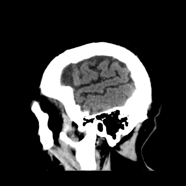 File:Brain Pantopaque remnants (Radiopaedia 78403-91048 C 49).jpg