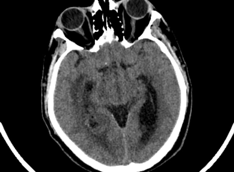 File:Brain abscess complicated by intraventricular rupture and ventriculitis (Radiopaedia 82434-96575 Axial non-contrast 25).jpg