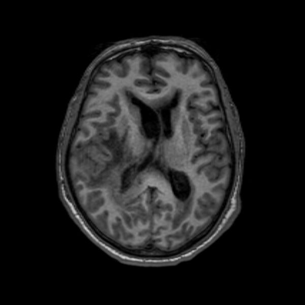 File:Brain abscess complicated by intraventricular rupture and ventriculitis (Radiopaedia 82434-96577 Axial T1 38).jpg