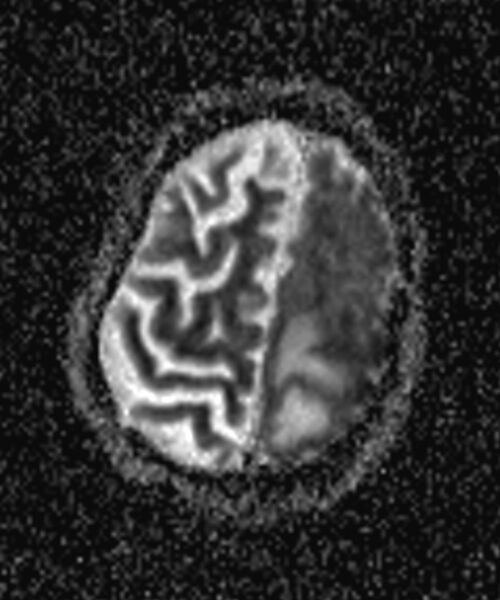 File:Brain abscess with dual rim sign (Radiopaedia 87566-103938 Axial ADC 17).jpg