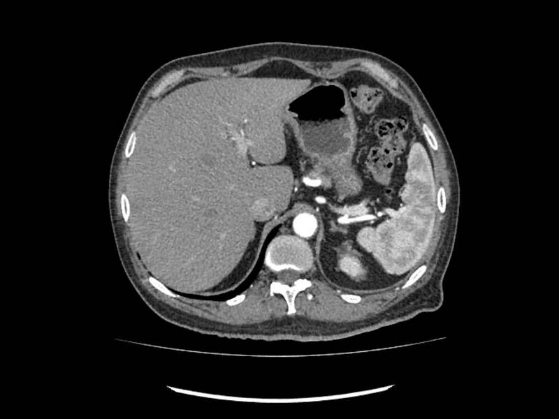 File:Brain metastases from renal cell carcinoma (Radiopaedia 42222-45328 A 1).jpg