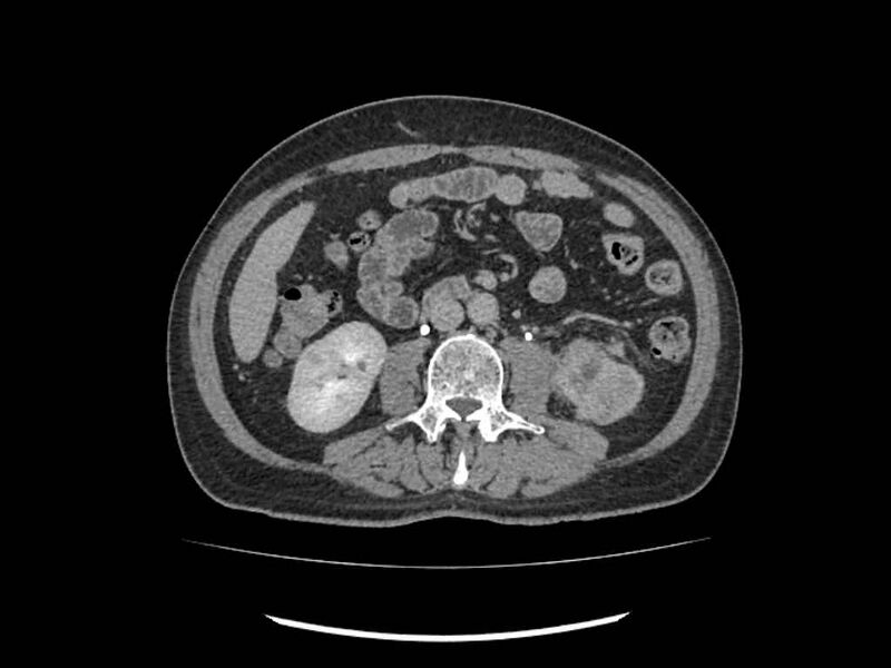 File:Brain metastases from renal cell carcinoma (Radiopaedia 42222-45328 Axial C+ delayed 142).jpg