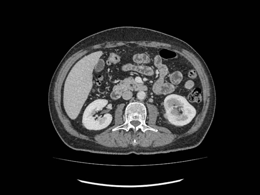 Brain metastases from renal cell carcinoma (Radiopaedia 42222-45328 B 105).jpg