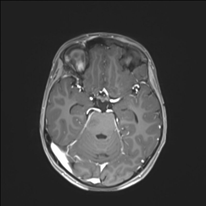 Brainstem glioma (Radiopaedia 70548-80674 Axial T1 C+ 64).jpg