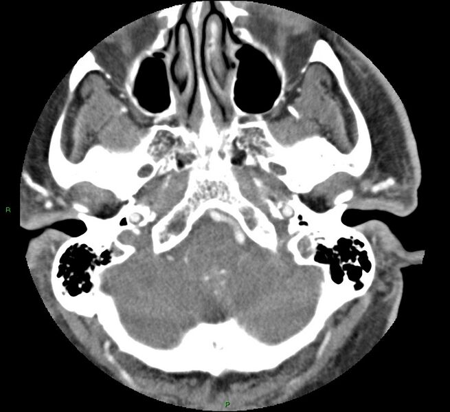 File:Brainstem hemorrhage (Radiopaedia 58794-66028 D 34).jpg