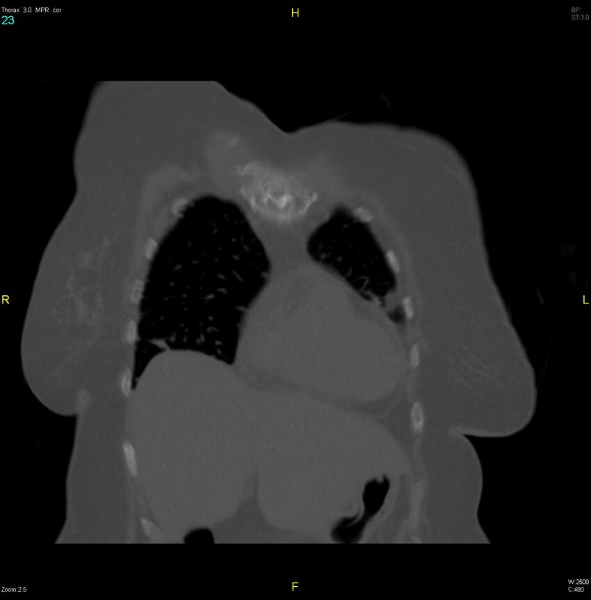 Breast primary with lung and bone metastases (Radiopaedia 40620-43228 bone window 23).jpg