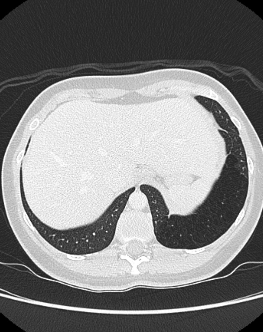 Bronchial atresia (Radiopaedia 50007-55297 Axial lung window 99).jpg