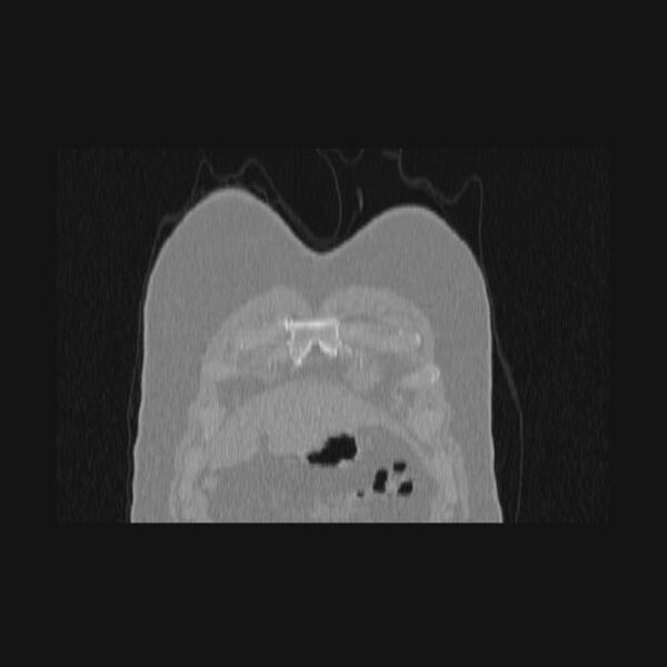 File:Bronchial atresia (Radiopaedia 60685-68439 Coronal lung window 76).jpg