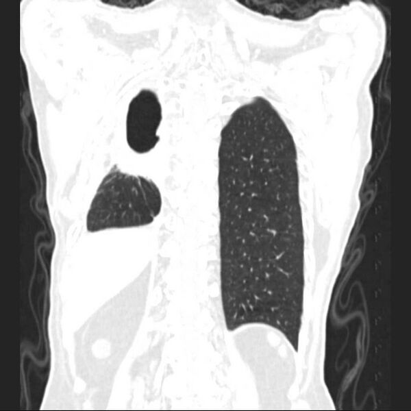 File:Bronchopleural fistula - postoperative complication (Radiopaedia 21020-20947 Coronal lung window 23).jpg