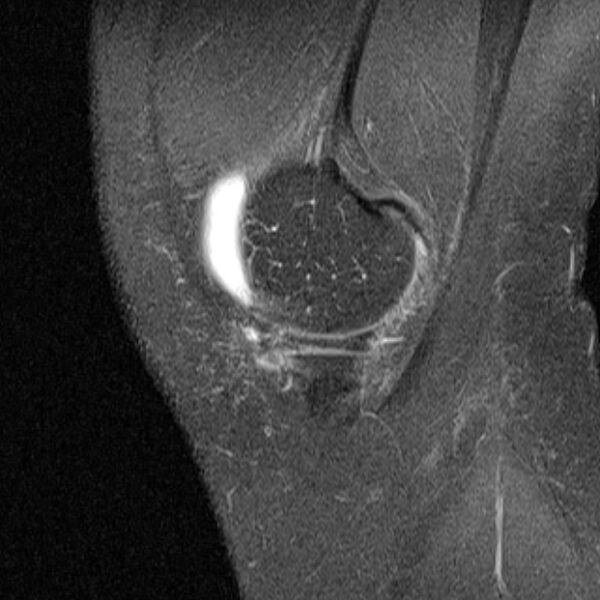 File:Bucket handle tear - medial meniscus (Radiopaedia 79028-91942 Sagittal PD fat sat 22).jpg