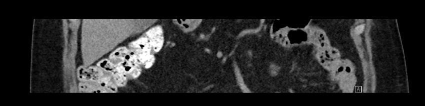Buried bumper syndrome - gastrostomy tube (Radiopaedia 63843-72575 Coronal Inject 38).jpg