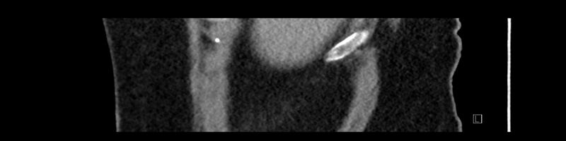 File:Buried bumper syndrome - gastrostomy tube (Radiopaedia 63843-72575 Sagittal Inject 112).jpg