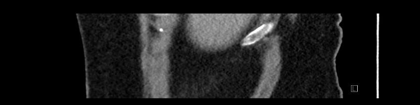 Buried bumper syndrome - gastrostomy tube (Radiopaedia 63843-72575 Sagittal Inject 112).jpg