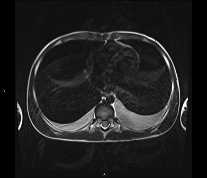 File:Burkitt lymphoma (bowel) (Radiopaedia 68839-78557 Axial T2 4).jpg