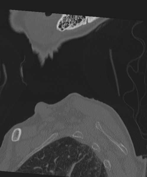 File:C2 fracture with vertebral artery dissection (Radiopaedia 37378-39199 Sagittal bone window 2).png