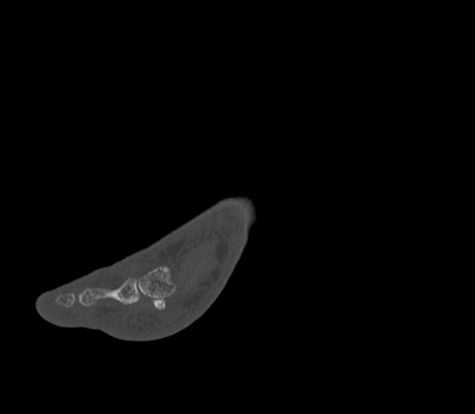 File:Calcaneal tuberosity avulsion fracture (Radiopaedia 22649-22668 Sagittal bone window 49).jpg