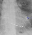 Calcified cardiac fibroma (Radiopaedia 39267-41518 C 1).jpg