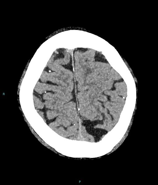 File:Calcified cerebral emboli from left ventricular thrombus (Radiopaedia 84420-99758 B 4).jpg