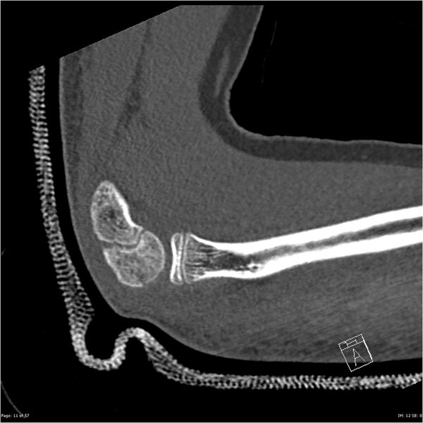 File:Capitellum fracture (Radiopaedia 23352-23426 Sagittal bone window 11).jpg