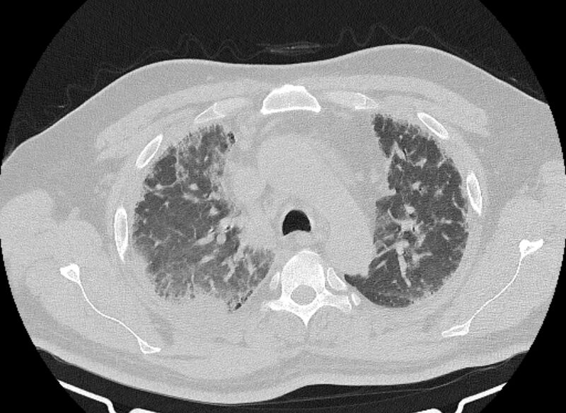 File:Cardiogenic pulmonary edema (Radiopaedia 68180-77678 Axial lung window 25).jpg