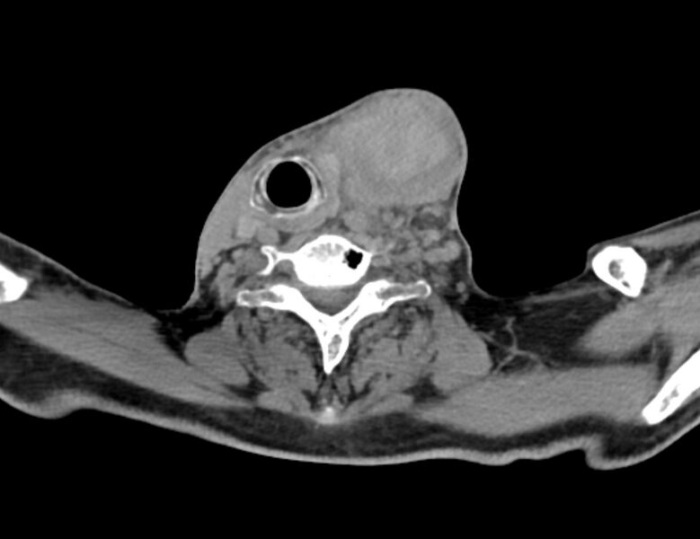 File:Carotid artery pseudoaneurysm (Radiopaedia 84030-99259 Axial non-contrast 40).jpg