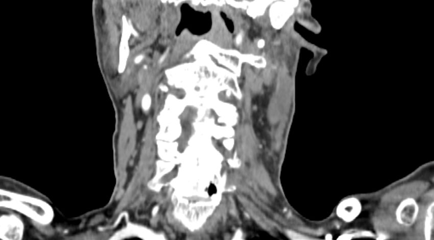 Carotid artery pseudoaneurysm (Radiopaedia 84030-99259 D 59).jpg