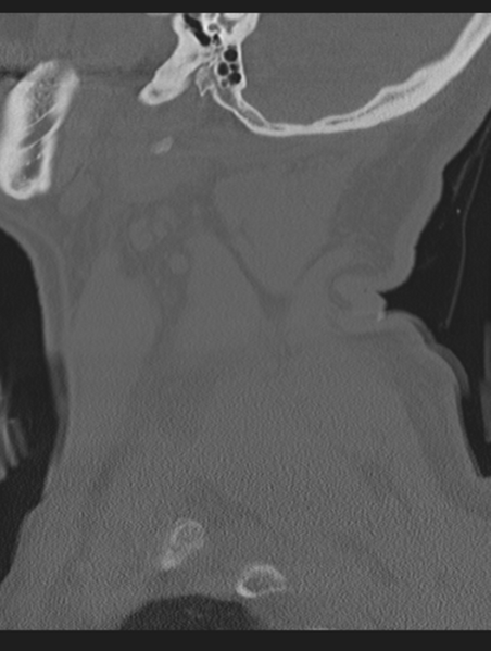 File:Cavernoma of cervical cord (Radiopaedia 50838-56346 Sagittal bone window 11).png